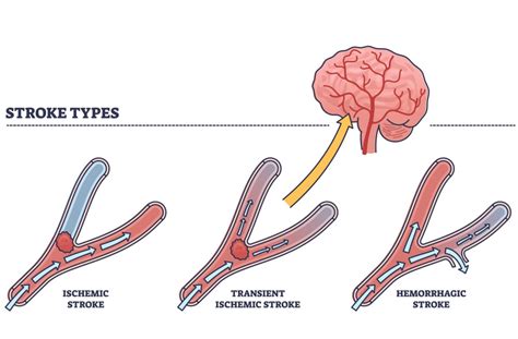 what symptoms are similar to tia